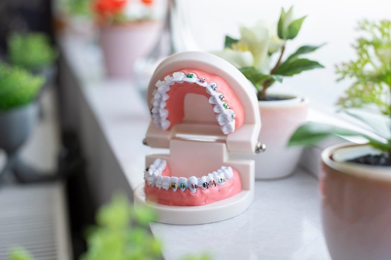 What To Know Before Getting Braces